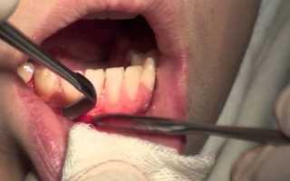 Проведение вестибулопластики нижней челюсти