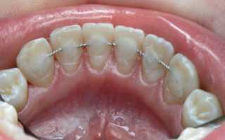 Ретейнеры после брекетов – закрепляем результат ортодонтического лечения