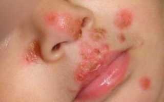 Заболевание стафилококк в носу у взрослых людей