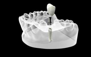 Аспекты дентальной имплантации при отсутствии нижних зубов