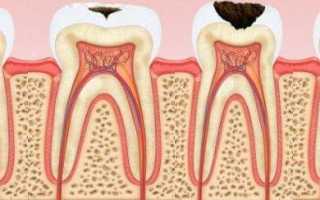 Кариес зубов: симптомы, стадии протекания заболевания и фото