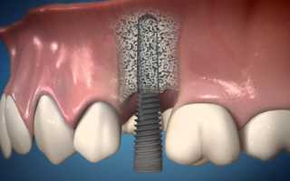 Значимые аспекты компрессионной имплантации зубов