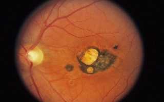 Как лечат токсоплазмоз глаз