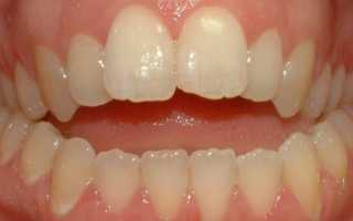 Открытый прикус зубов у детей и взрослых