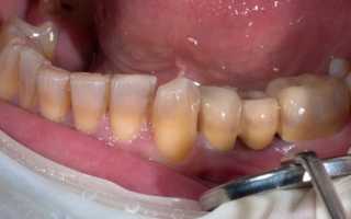 Тетрациклиновые зубы: признаки и терапия заболевания