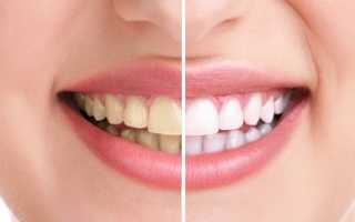 Желтый налет на зубах: причины появления и удаление