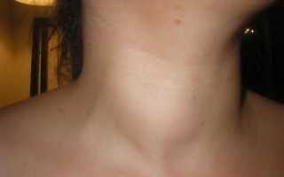 Причины образования узлов щитовидной железы