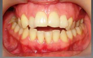 Способы и прогноз лечения сужения челюстей и зубных рядов