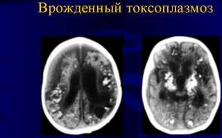 Токсоплазмоз головного мозга