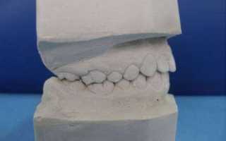 Назначение и универсальные свойства гипса для ортопедической стоматологии