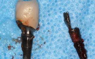 Удаление импланта зуба – коротко о неприятном
