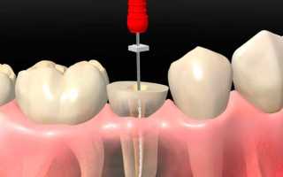Есть ли необходимость в депульпации зубов перед протезированием