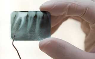 Особенности клиники и способы устранения кисты под коронкой зуба