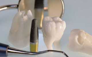 Суть ультразвуковой имплантации зубов и аспекты ее проведения