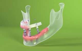 Имплантация Pro Arch – полный зубной ряд и белоснежная улыбка за несколько часов
