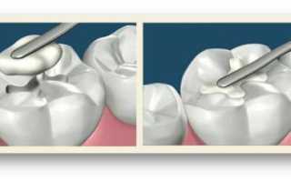 О качестве реставрации зубов с помощью цементных пломб