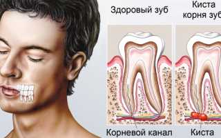 Какие симптомы свидетельствуют о кисте зуба?