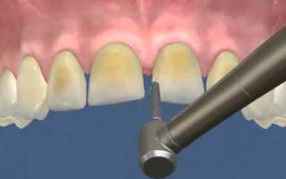 Препарирование зуба под винир – залог качественной эстетической реставрации