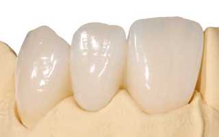 Технология реставрации зубов фронтальной зоны стеклокерамическими коронками