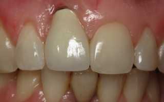 Какая опасность того, что из-под коронки зуба сочится кровь?