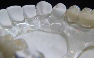 Зубные протезы Квадротти: описание, плюсы и минусы, стоимость