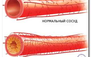 Что такое инсулиновая резистентность: симптомы, причины, лечение