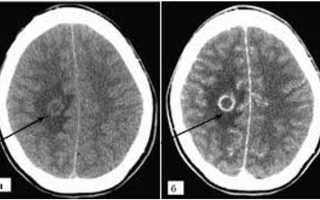 Что это такое нейроцистицеркоз и каковы его симптомы