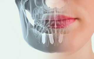 Преимущества использования 3D навигации при имплантации зубов