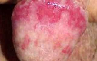 Сыпь, выделения и другие признаки хламидиоза