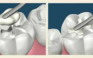 Особенности использования стеклоиономерного цемента для пломбирования зубов