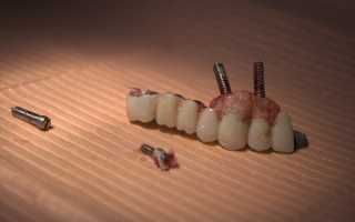 Основные провокаторы отторжения зубных имплантов