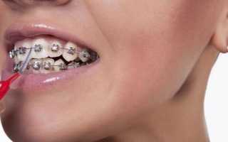 Зубные щетки для брекетов: необходимость в использовании и описание видов