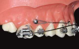 Что представляет собой анкораж и как его применяют в ортодонтии