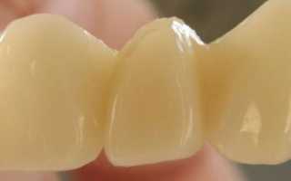 Пластмассовые коронки на передние зубы: отзывы, плюсы и минусы, стоимость