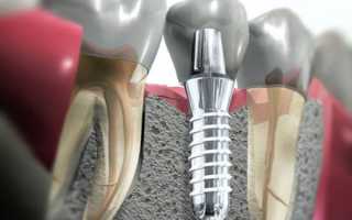 Тонкости ускоренной и щадящей экспресс имплантации зубов