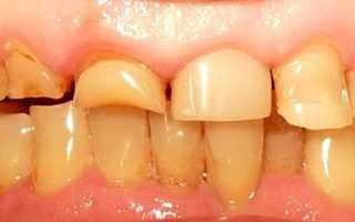 Некариозные поражения зубов у человека