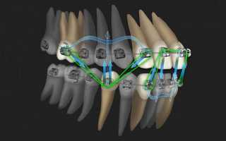 Особенности перестройки костной ткани альвеолярного отростка при перемещении зуба