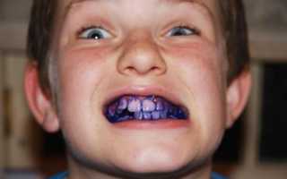 Индикатор зубного налета — лучший помощник в уходе за полостью рта