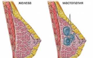 Как быстро вылечить мастопатию?