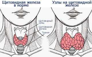 Насколько опасен узел в щитовидной железе