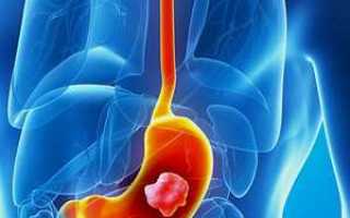 Рак желудка на УЗИ брюшной полости: видно ли, признаки злокачественного процесса