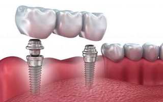 Имплантаты Oraltronics ― оптимальный подход к удобству специалиста и комфорту пациента