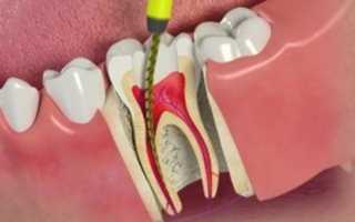 Экстирпация пульпы — эффективный способ сохранения зуба