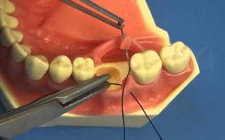 Ушивание лунки зуба – простой и безопасный способ восстановления альвеолярного отростка после удаления