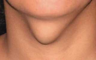 Как лечить кисту щитовидной железы