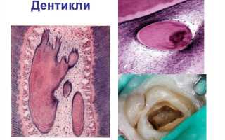 Дентикли – не окончательно изученное явление как итог минерализации коронковой и корневой пульпы