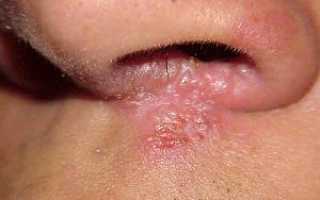 Симптомы золотистого стафилококка в носу у взрослых людей