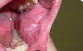 Лейкоплакия полости рта: признаки и способы избавления от недуга