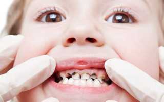 Особенности лечения кариеса молочных зубов