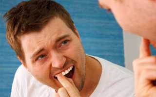 Определение степени подвижности зубов и способы их укрепления